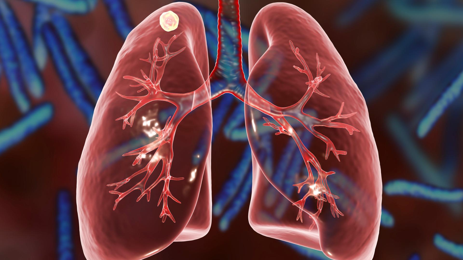 pulmones enfermos