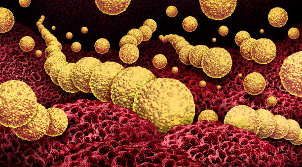 Ilustración médica sobre fascitis necrotizante